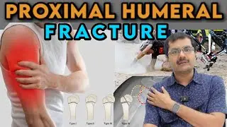 What is the fastest way to heal a broken shoulder? Proximal Humerus Fractuere I Dr Soundar I Tamil