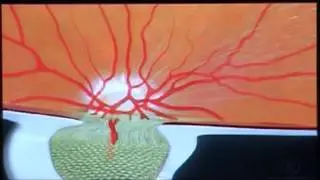 Nervo &Oacute;ptico 2 - Visare Hospital de Olhos