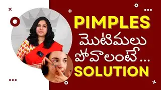 Pimple Solution by Dr. Deepthi | Diet for Acne in Telugu | Crowns Clinic