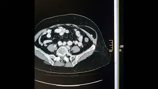 Differences between Spigelian hernia and simple anterior abdominal wall hernia.