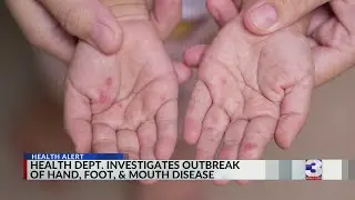 Health Dept. Investigates outbreak of hand, foot, and mouth disease