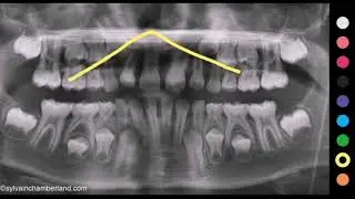 ترتيب بزوغ الأسنان عند الأطفال