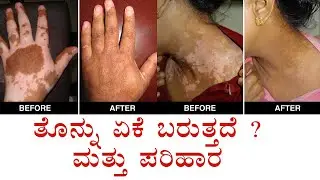 ತೊನ್ನು ಏಕೆ ಬರುತ್ತದೆ ? ಮತ್ತು ಪರಿಹಾರ Vitiligo Types ,Symptoms, Causes,Treatment & Recovery | Dr shilpa