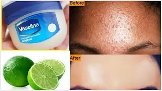 How To Get Rid of Pimples|(Acne) Overnight With Vaseline and Lemon