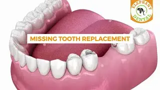 Missing Teeth Replacement with Implant VS Bridge #elephantdental