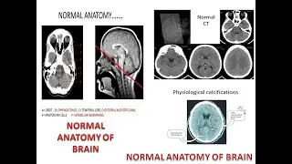 how to read Ct scan of  Brain |Anatomy of Brain