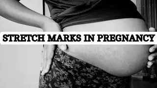 STRETCH MARKS IN PREGNANCY | WILL THEY EVER FADE ? | DOES EVERYONE HAVE THEM ?