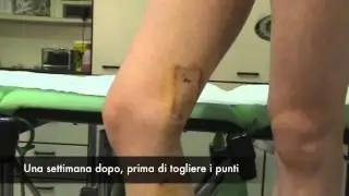 Vene Varicose: Il test del laccio nella programmazione di un intervento conservativo. by veneinforma