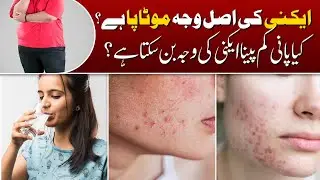 What are Acne Types? How to Prevent Acne Scars? Doctor Answers Acne Questions | Cosmetique