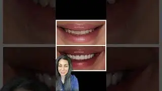 Smile makeover before and after | porcelain veneers before and after | Dr. Yazdan | #veneers