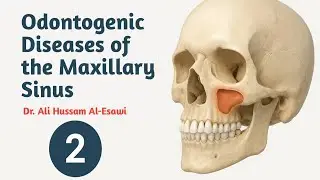 Odontogenic diseases of maxillary sinus | جراحة الفم | المرحلة الخامسة