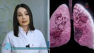 TƏBİB Məsləhəti | Ağciyər vərəmini yaradan səbəblər barədə