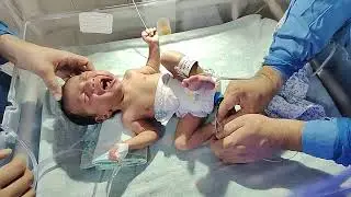 Congenital Hypoplasia of Depressor Angularis Oris Muscle #clinicaltraining,#pediatrics,#neonatalcare