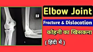 Elbow Joint Xray Reading | Fracture Radial Head | Elbow Dislocation | Uday Xray