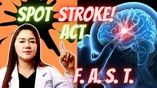 Stroke and Physical Therapy: Wonders of rehabilitation in stroke patients | Doc Cherry