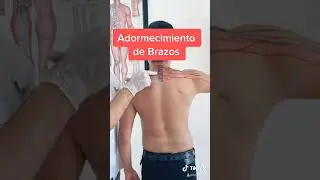Adormecimiento en Brazos. Plexo Cervical.