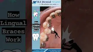how lingual braces work | lingual braces