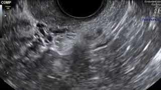Video 12: Uterosacral ligaments in deep endometriosis caused by hydroureter