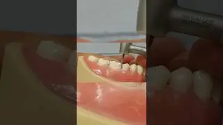 Finish line preparation (tooth reduction)