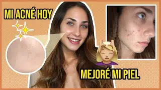 C&oacute;mo mejor&eacute; mi piel con ACN&Eacute; | Roaccutan | Juli Berea
