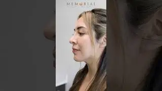 Pointy nose? Say no more. Rhinoplasty is the key to unlock your dream!