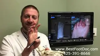 Hammer Toe -- Treatments and Information