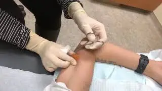 Getting my birth control (Nexplanon) taken out *Warning Graphic*