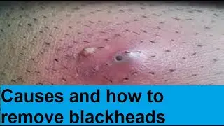 how to remove blackheads