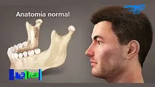 ¿Qué es la reabsorción ósea en odontología?