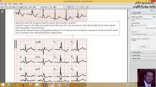 12 BUNDLE BRANCH BLOCK (LBBB) Prof.Dr.mahmoud Allam