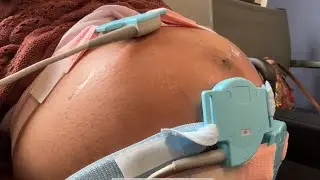 34 недели 6 дней, двойня 🤰 Нестрессовый тест (НСТ)
