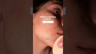 Сыворотка: #WW295625 (вб)🙏 Моя кожа до/после на видео&hellip; #прыщи #отпрыщей #уходзакожей РП