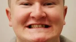 Orthodontic results - Fixed Braces