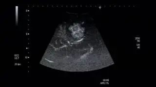 Imaging FNH with CEUS on Toshiba Aplio