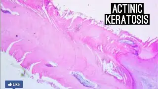 Actinic Keratosis