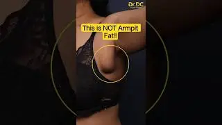 Underarm Bulge That Won&rsquo;t Go Away? It&rsquo;s NOT Fat! | Dr DC, Plastic Surgeon | Pune