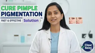  Pimple बहुत ज्यादा हो रहे है क्या करे । Oil skin problems Pimple  , Scars  को कैसे करे ठीक।   