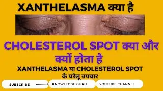 removeing xanthelasma (cholesterolspot):, what is cholesterol spot, home remedies for zanthelasma