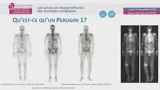 Que faire devant un Perugini 1 ? Les limites et pi&egrave;ges de la scintigraphie. MAC- O.LAIREZ