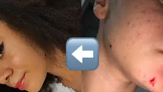 COMO CUIDO DAS MINHAS ESPINHAS: DICAS PARA QUEM TEM ACNE