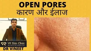 ओपन पोर्स के कारण और ईलाज | OPEN PORES CAUSES & TREATMENT| DR VINEET| BIKANER| VR SKIN CLINIC