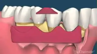 Gum Disease Treatment   Gum Surgery for Receding Gums   Implant & Gumcare Center Dallas TX