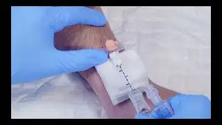 Inbrengen canule perifeer infuus