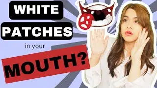 Oral Thrush - Top 2 Treatments (How To Treat Oral Yeast Infection)