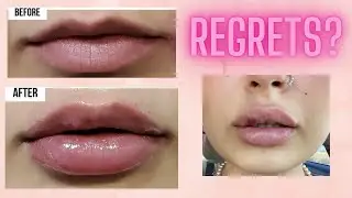 ИНЪЕКЦИИ ДЛЯ УВЕЛИЧЕНИЯ ГУБ (ВОПРОСЫ И ОТВЕТЫ) - JUVEDERM VOLBELLA, JUVEDERM ULTRA PLUS