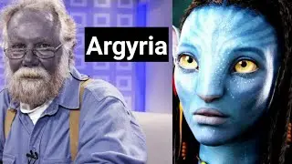 This disease turns your skin blue (Argyria)