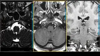 39Glossopharyngeal Nerve Course   MRI Online