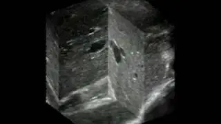 3D ultrasound