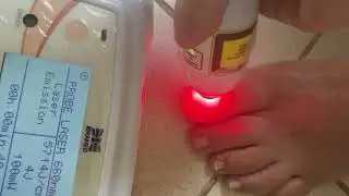 Laser pulse 660 na micose de unhas
