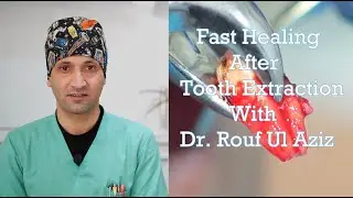 All You Need To Do After Tooth Extraction | Post Extraction Instructions Made Easy.